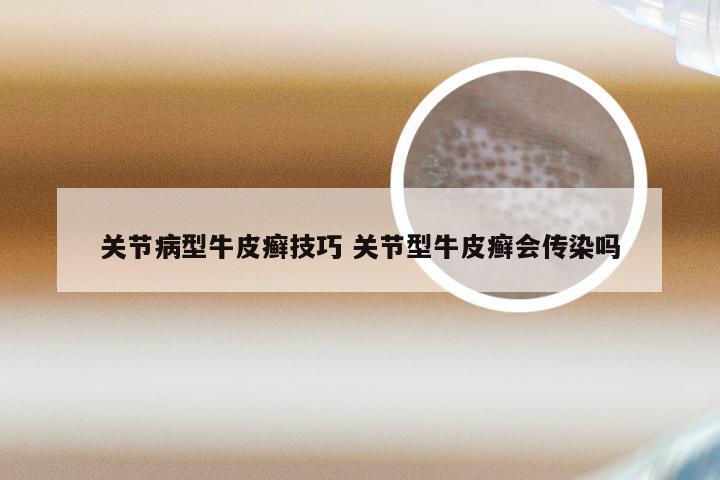 关节病型牛皮癣技巧 关节型牛皮癣会传染吗