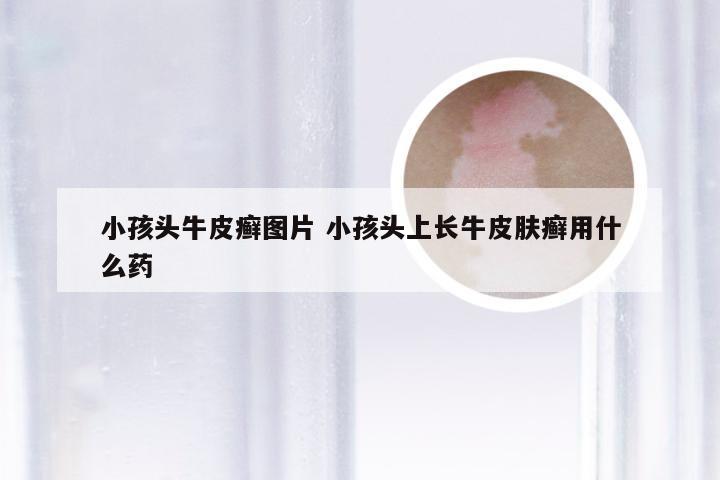 小孩头牛皮癣图片 小孩头上长牛皮肤癣用什么药