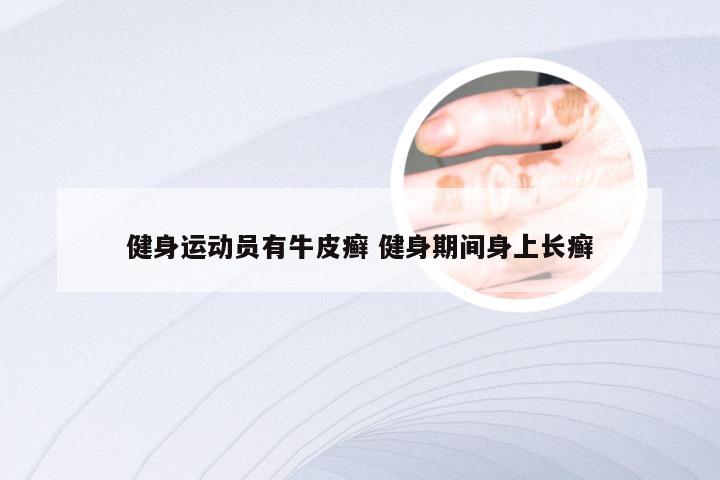 健身运动员有牛皮癣 健身期间身上长癣