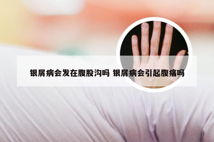 银屑病会发在腹股沟吗 银屑病会引起腹痛吗