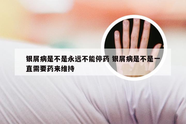 银屑病是不是永远不能停药 银屑病是不是一直需要药来维持
