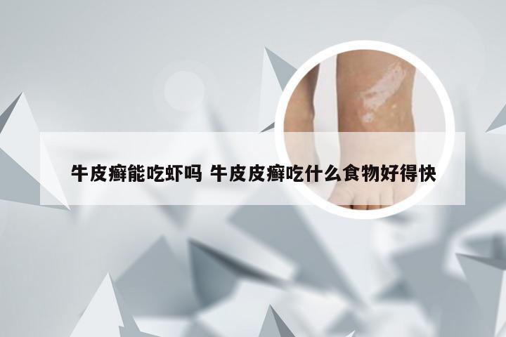 牛皮癣能吃虾吗 牛皮皮癣吃什么食物好得快