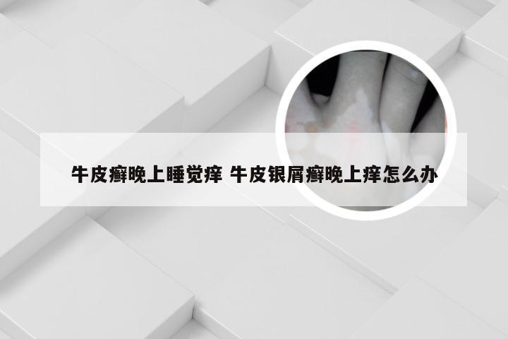 牛皮癣晚上睡觉痒 牛皮银屑癣晚上痒怎么办
