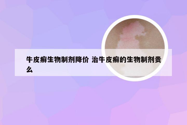 牛皮癣生物制剂降价 治牛皮癣的生物制剂贵么