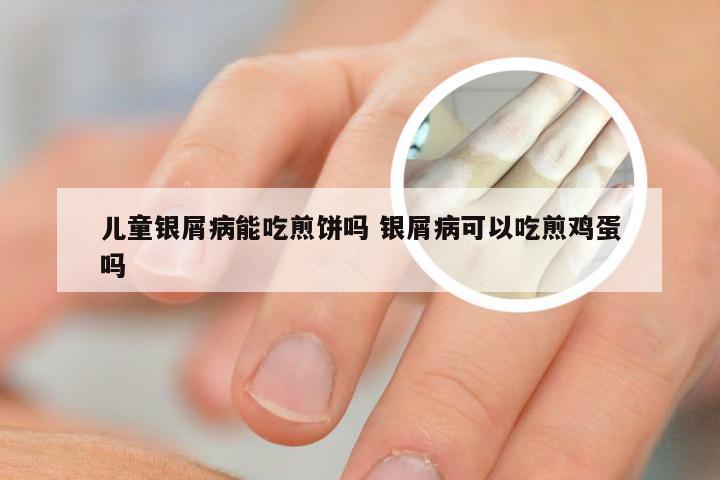 儿童银屑病能吃煎饼吗 银屑病可以吃煎鸡蛋吗