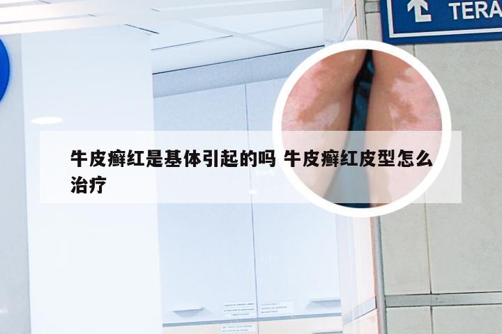 牛皮癣红是基体引起的吗 牛皮癣红皮型怎么治疗