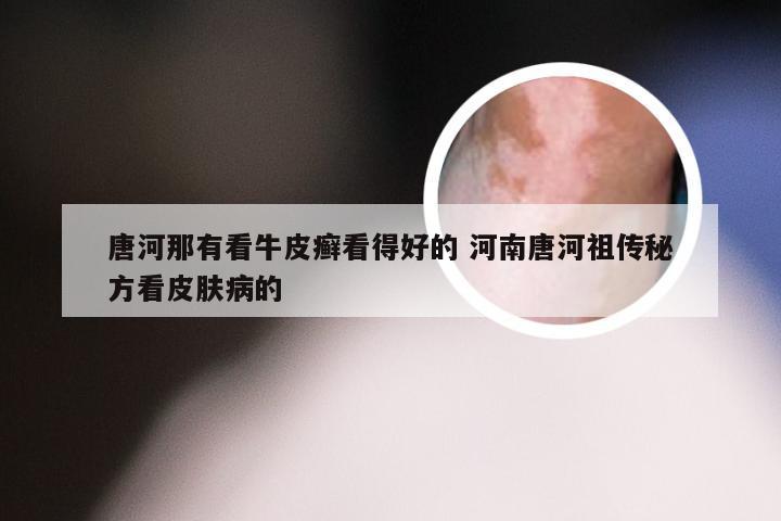 唐河那有看牛皮癣看得好的 河南唐河祖传秘方看皮肤病的