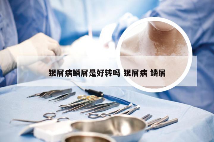 银屑病鳞屑是好转吗 银屑病 鳞屑