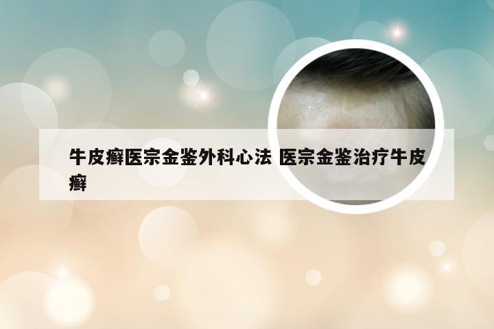 牛皮癣医宗金鉴外科心法 医宗金鉴治疗牛皮癣