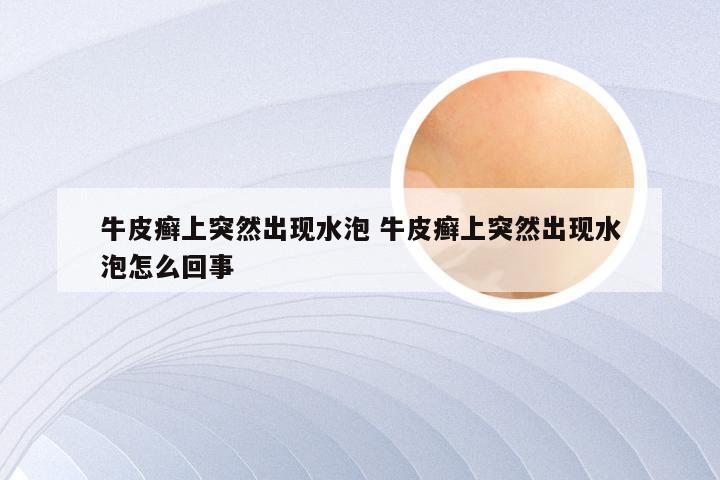 牛皮癣上突然出现水泡 牛皮癣上突然出现水泡怎么回事
