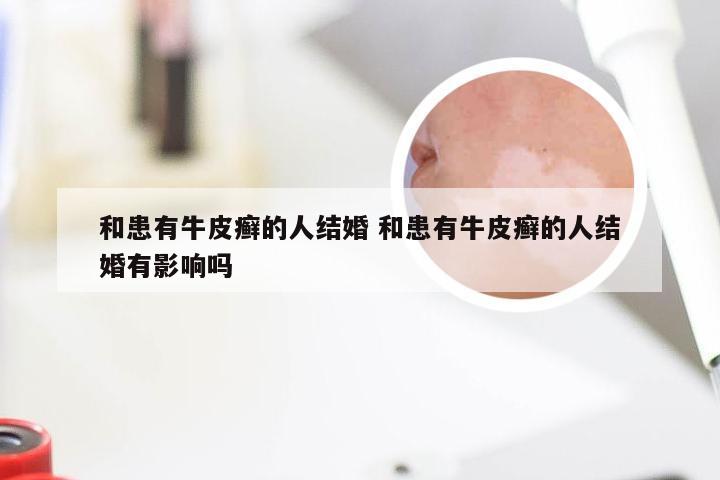 和患有牛皮癣的人结婚 和患有牛皮癣的人结婚有影响吗