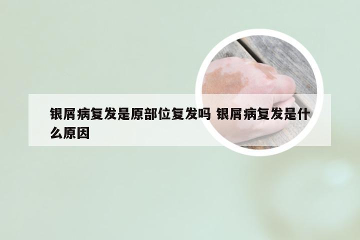 银屑病复发是原部位复发吗 银屑病复发是什么原因