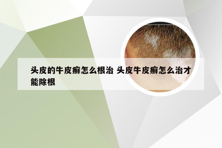 头皮的牛皮癣怎么根治 头皮牛皮癣怎么治才能除根