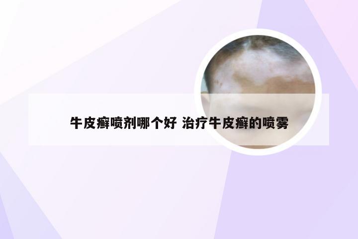 牛皮癣喷剂哪个好 治疗牛皮癣的喷雾