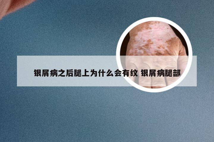 银屑病之后腿上为什么会有纹 银屑病腿部