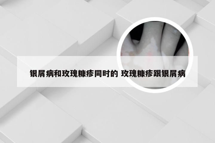 银屑病和玫瑰糠疹同时的 玫瑰糠疹跟银屑病