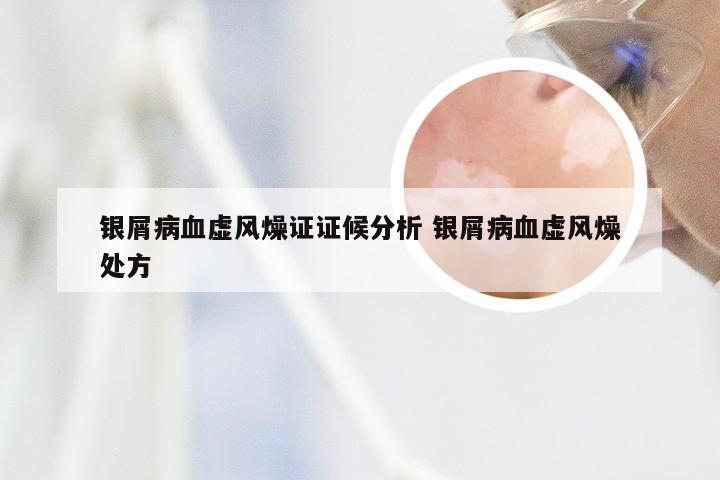 银屑病血虚风燥证证候分析 银屑病血虚风燥处方