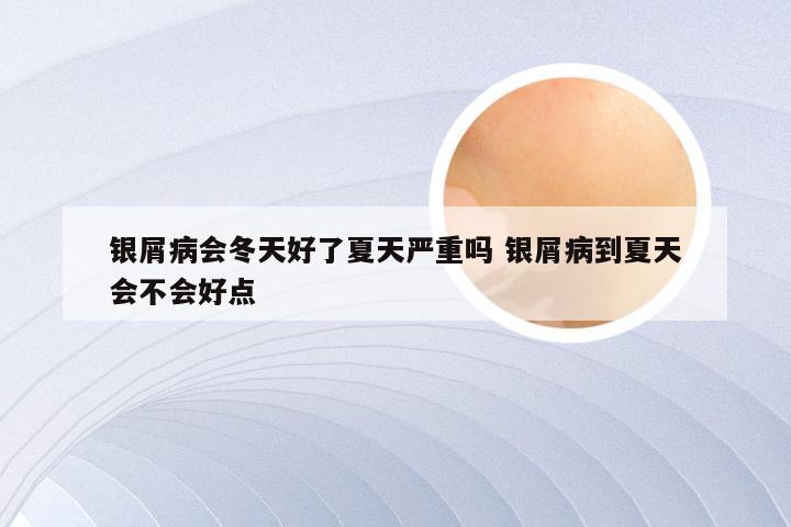 银屑病会冬天好了夏天严重吗 银屑病到夏天会不会好点