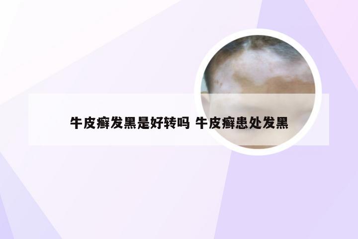 牛皮癣发黑是好转吗 牛皮癣患处发黑
