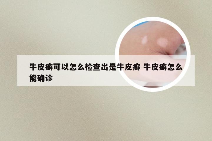 牛皮癣可以怎么检查出是牛皮癣 牛皮癣怎么能确诊