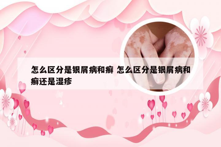 怎么区分是银屑病和癣 怎么区分是银屑病和癣还是湿疹