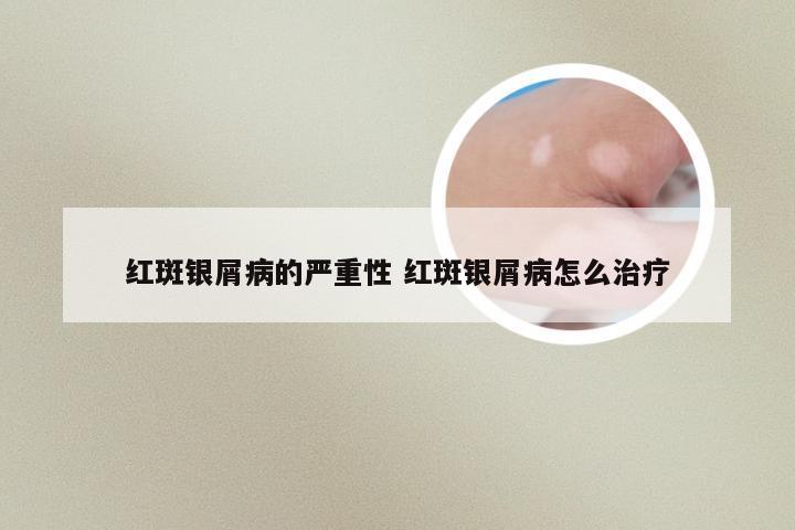 红斑银屑病的严重性 红斑银屑病怎么治疗