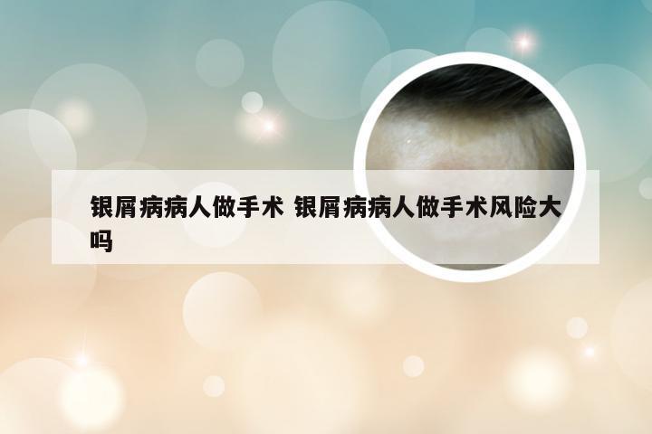 银屑病病人做手术 银屑病病人做手术风险大吗