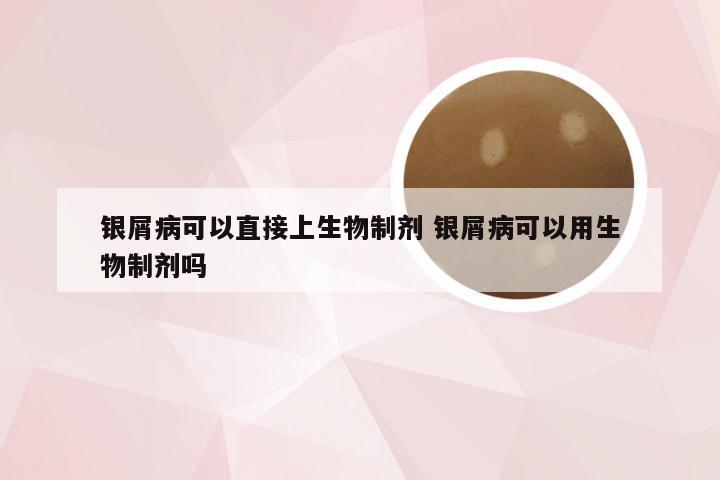 银屑病可以直接上生物制剂 银屑病可以用生物制剂吗
