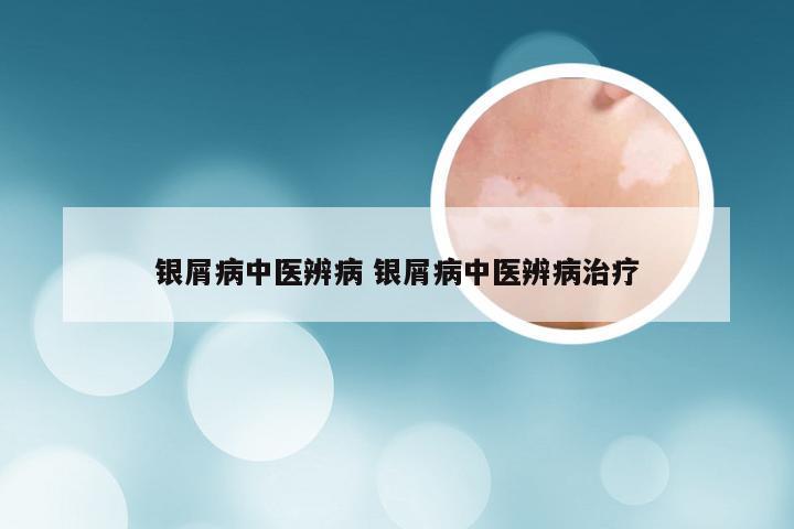 银屑病中医辨病 银屑病中医辨病治疗