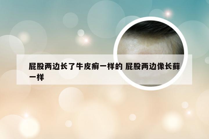 屁股两边长了牛皮癣一样的 屁股两边像长藓一样