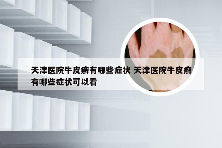 天津医院牛皮癣有哪些症状 天津医院牛皮癣有哪些症状可以看