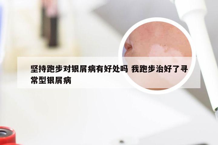 坚持跑步对银屑病有好处吗 我跑步治好了寻常型银屑病