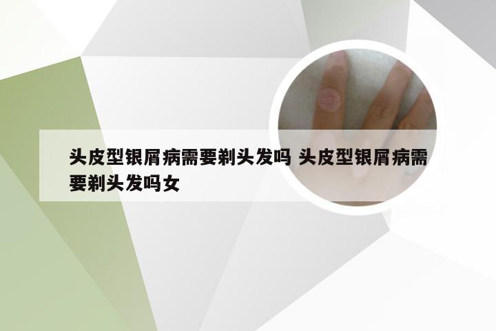 头皮型银屑病需要剃头发吗 头皮型银屑病需要剃头发吗女