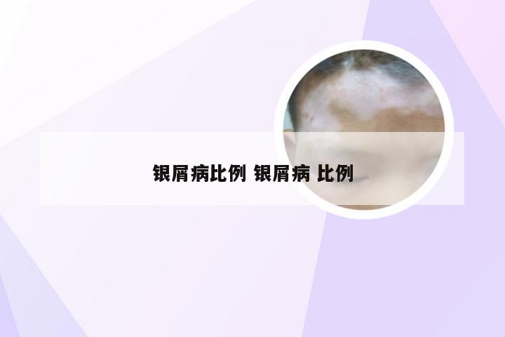 银屑病比例 银屑病 比例