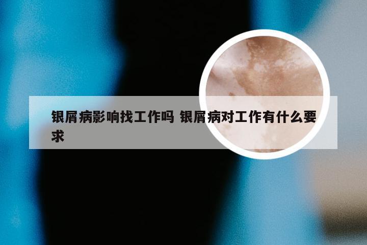 银屑病影响找工作吗 银屑病对工作有什么要求
