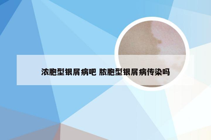 浓胞型银屑病吧 脓胞型银屑病传染吗