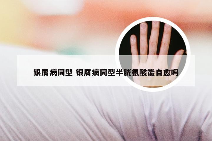 银屑病同型 银屑病同型半胱氨酸能自愈吗