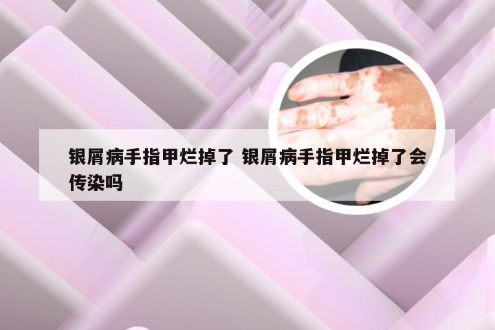 银屑病手指甲烂掉了 银屑病手指甲烂掉了会传染吗