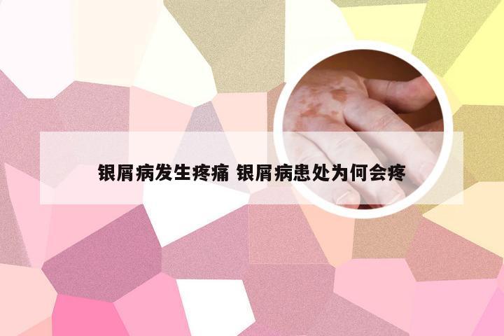 银屑病发生疼痛 银屑病患处为何会疼