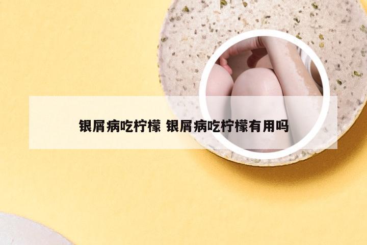 银屑病吃柠檬 银屑病吃柠檬有用吗