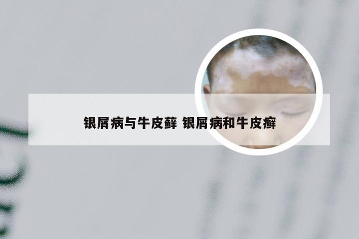 银屑病与牛皮藓 银屑病和牛皮癣