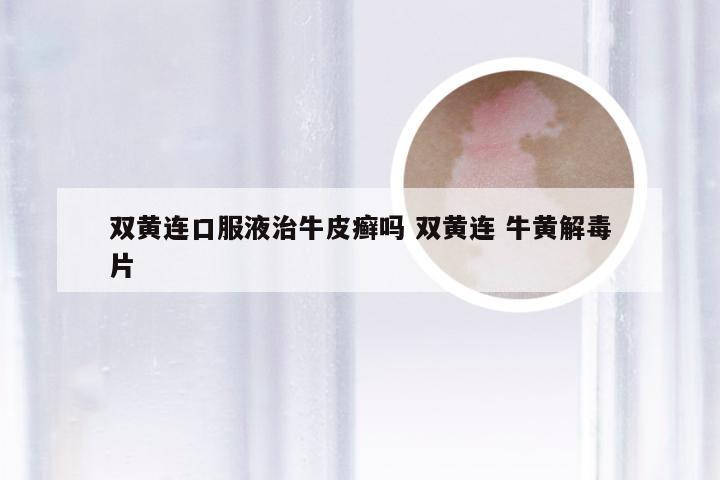 双黄连口服液治牛皮癣吗 双黄连 牛黄解毒片