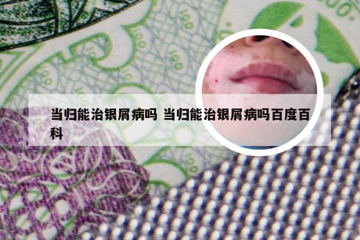当归能治银屑病吗 当归能治银屑病吗百度百科