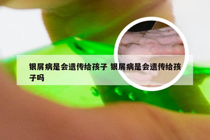 银屑病是会遗传给孩子 银屑病是会遗传给孩子吗