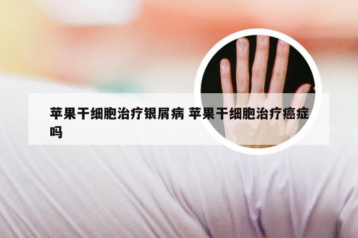 苹果干细胞治疗银屑病 苹果干细胞治疗癌症吗