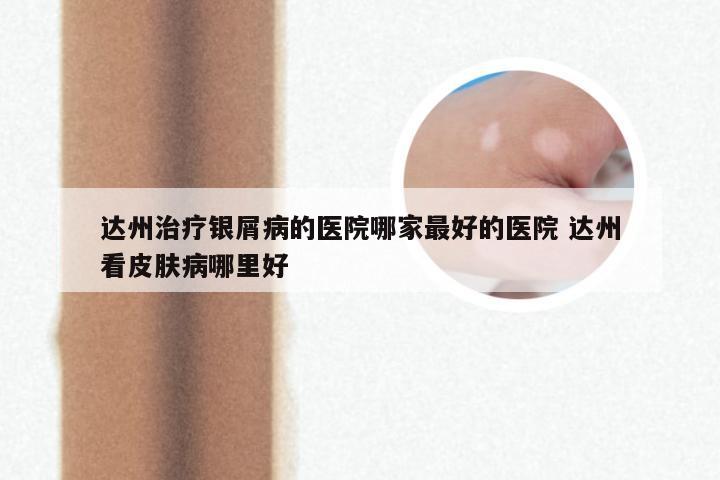 达州治疗银屑病的医院哪家最好的医院 达州看皮肤病哪里好