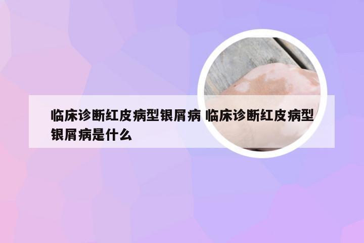 临床诊断红皮病型银屑病 临床诊断红皮病型银屑病是什么