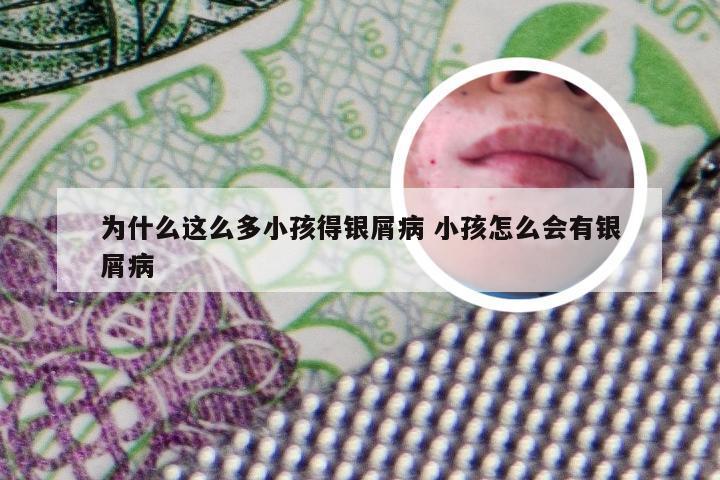 为什么这么多小孩得银屑病 小孩怎么会有银屑病