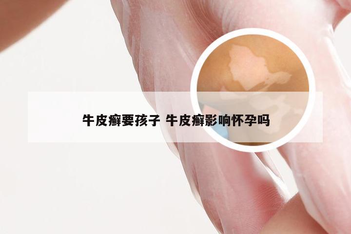 牛皮癣要孩子 牛皮癣影响怀孕吗