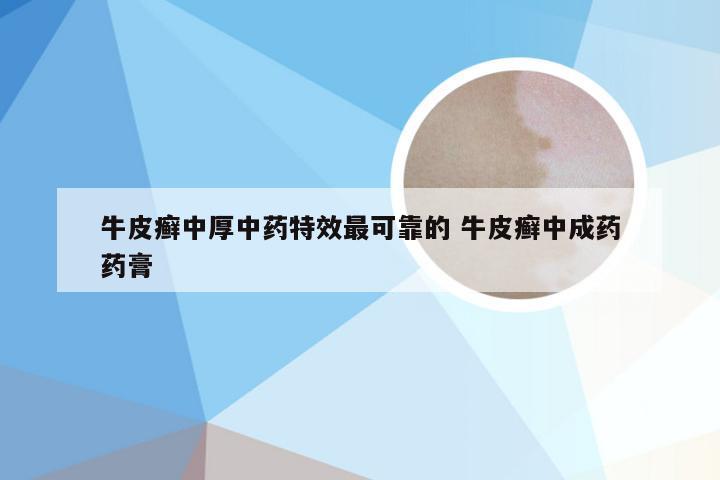 牛皮癣中厚中药特效最可靠的 牛皮癣中成药药膏